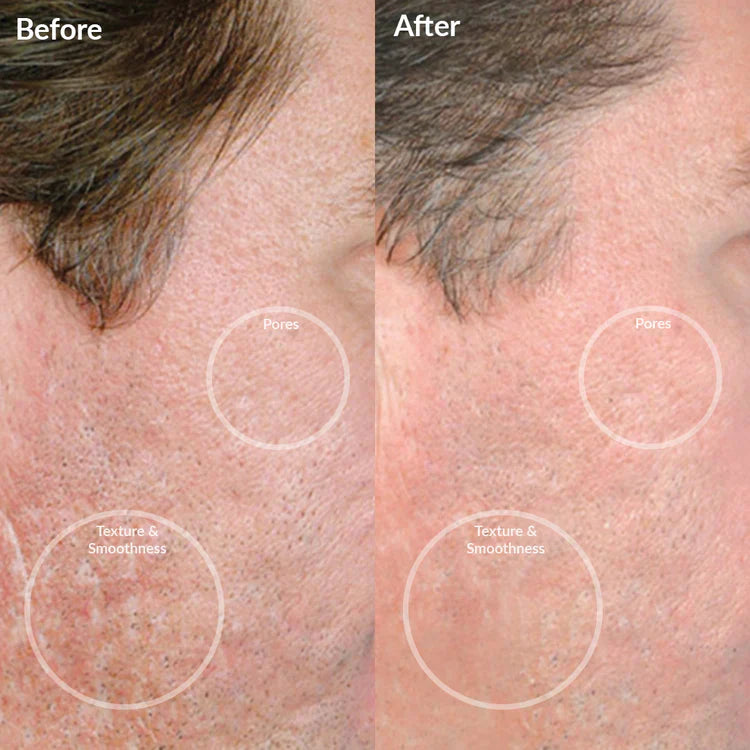 PMD Personal Microderm Pro - Black